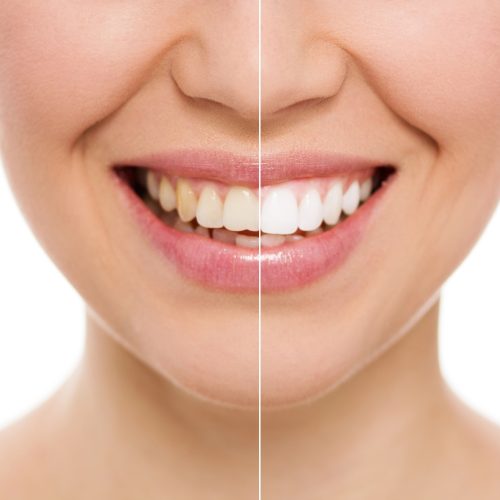 Teeth Whitening Simcoe